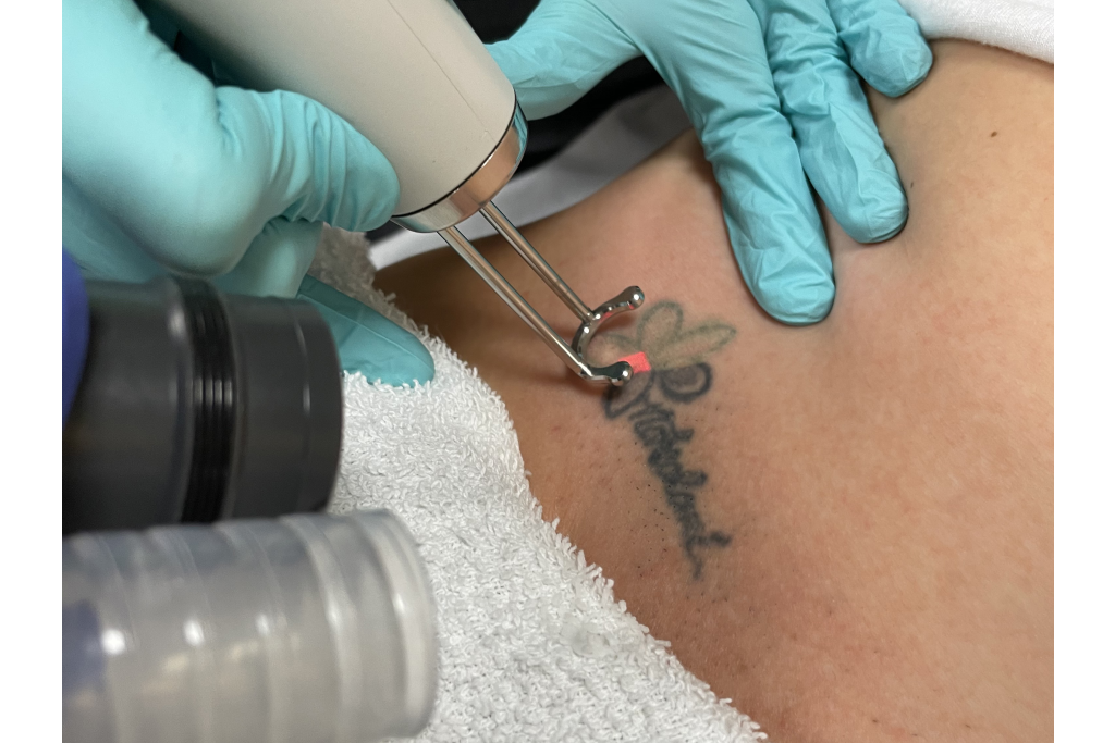 Tattoo Removal Procedure / Find A Good Laser Tattoo ...