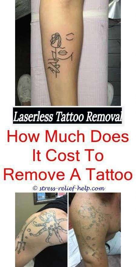 tattoo removal results how to remove tattoo from hand ...