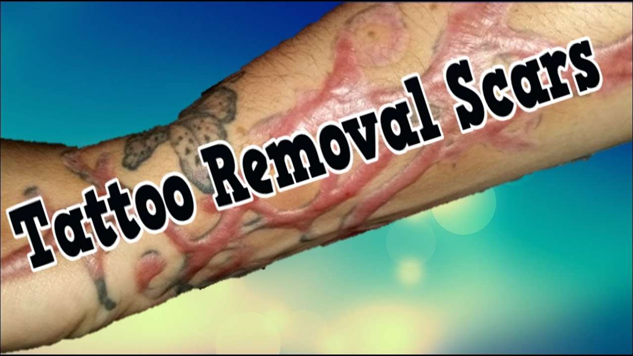 Tattoo Removal Scars, Can You Remove Tattoos, How To ...