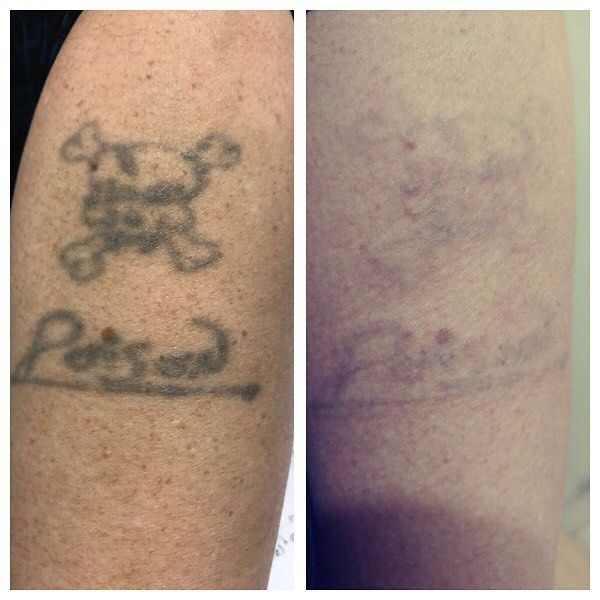 Tattoo Removal Second Session