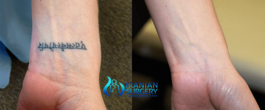 Tattoo removal surgery