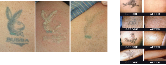Tattoo Removal The Cost