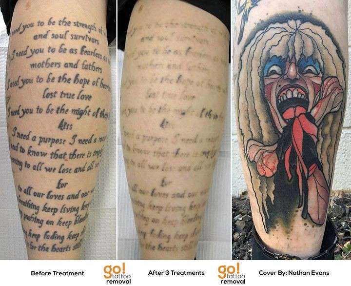 Tattoo Removal to Tattoo Cover