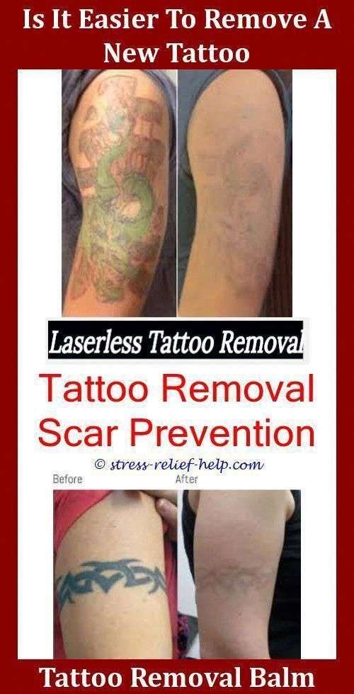 Tattoo Removal Toronto,can tattoos be removed tattoo removal cardiff ...