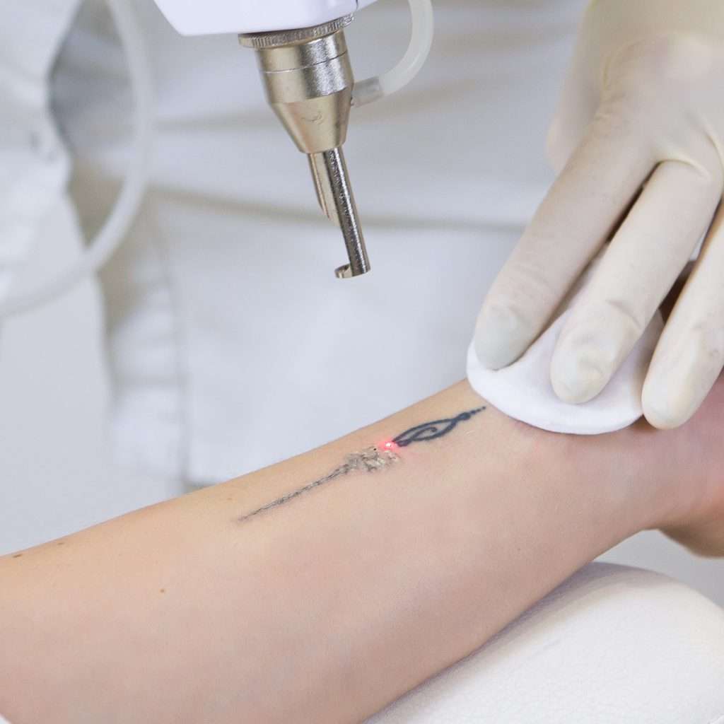Tattoo Removal Treatments at Cheshire Lasers Clinic in Middlewich.