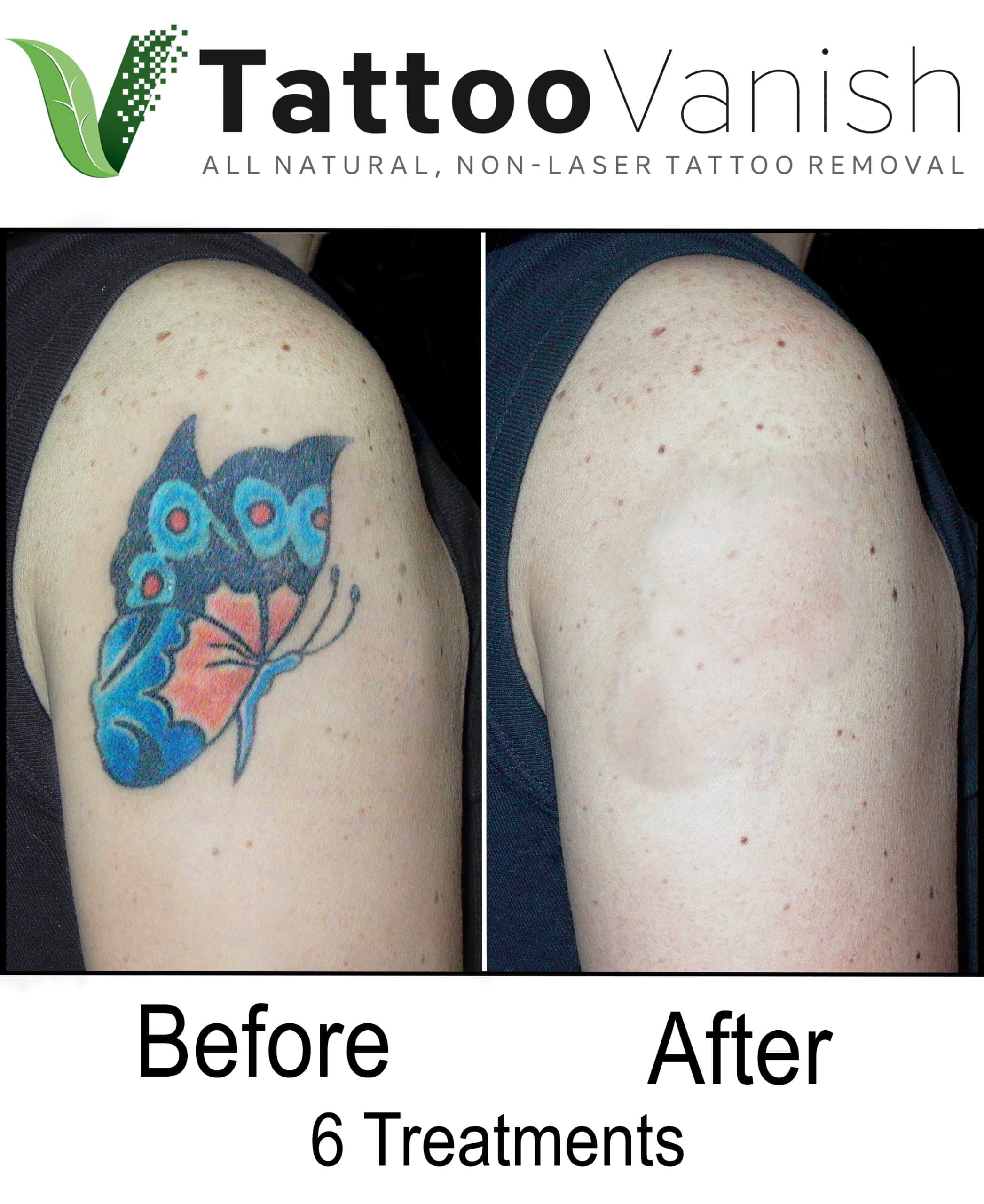 Tattoo Removal Twin Cities