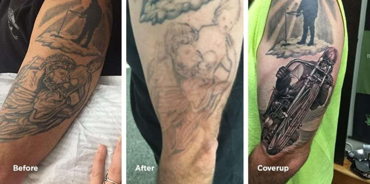 Tattoo Removal vs. Cover Up