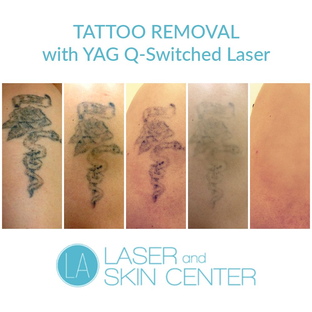 Tattoo Removal While more and more people are opting to get tattoos ...