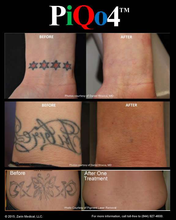 Tattoo Removal with Less Pain, 40% Fewer Treatments and Clearance of ...