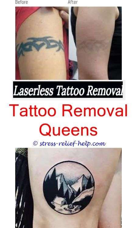 tattoo shirt can amalgam tattoos be removed