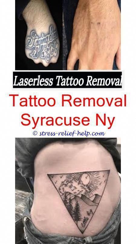 tattoo supplies tattoo removal company