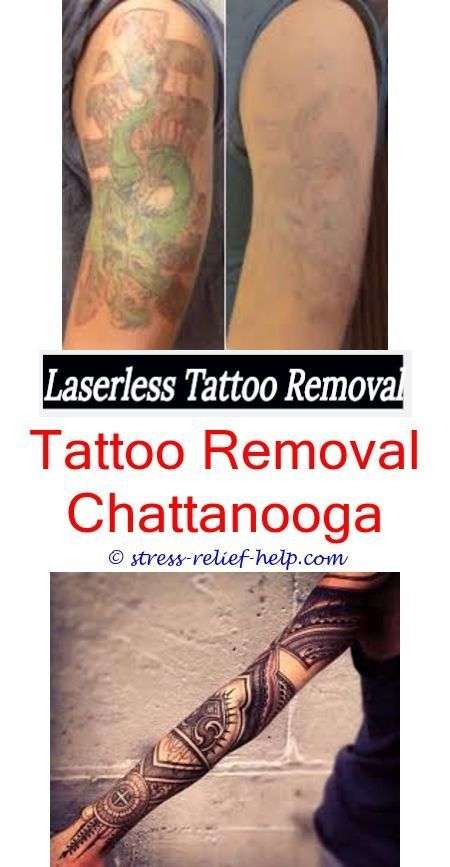 tattoo treatment how to remove tattoo faster