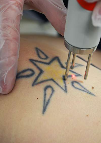 Tattoo Treatment18 web