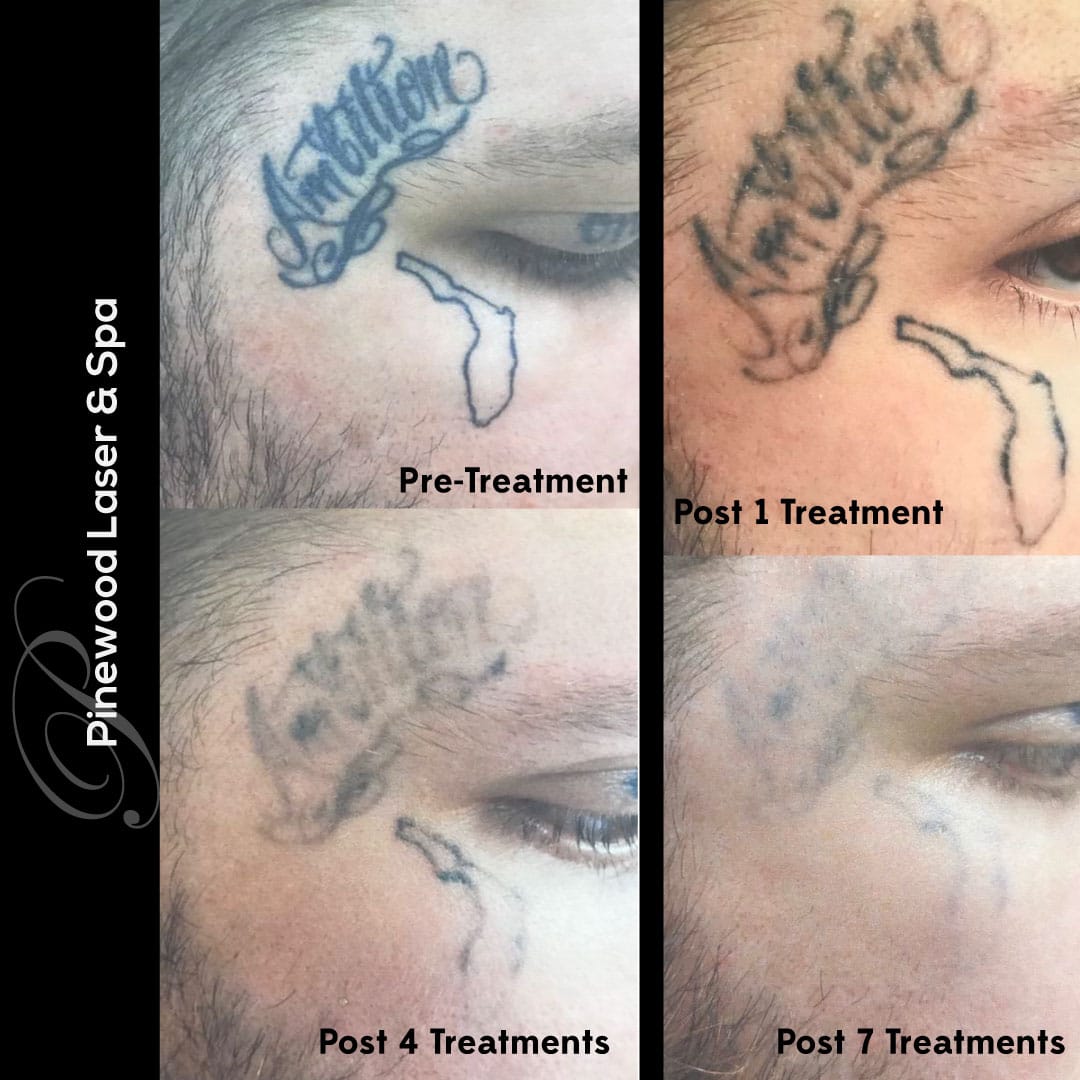TattooBefore& After_Ambition