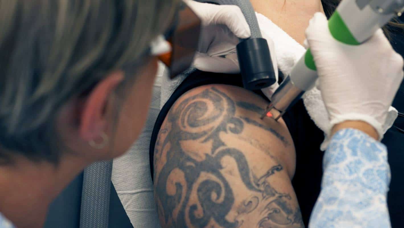 The art of the tattoo, removal: tribal designs, Felix the cat and light ...
