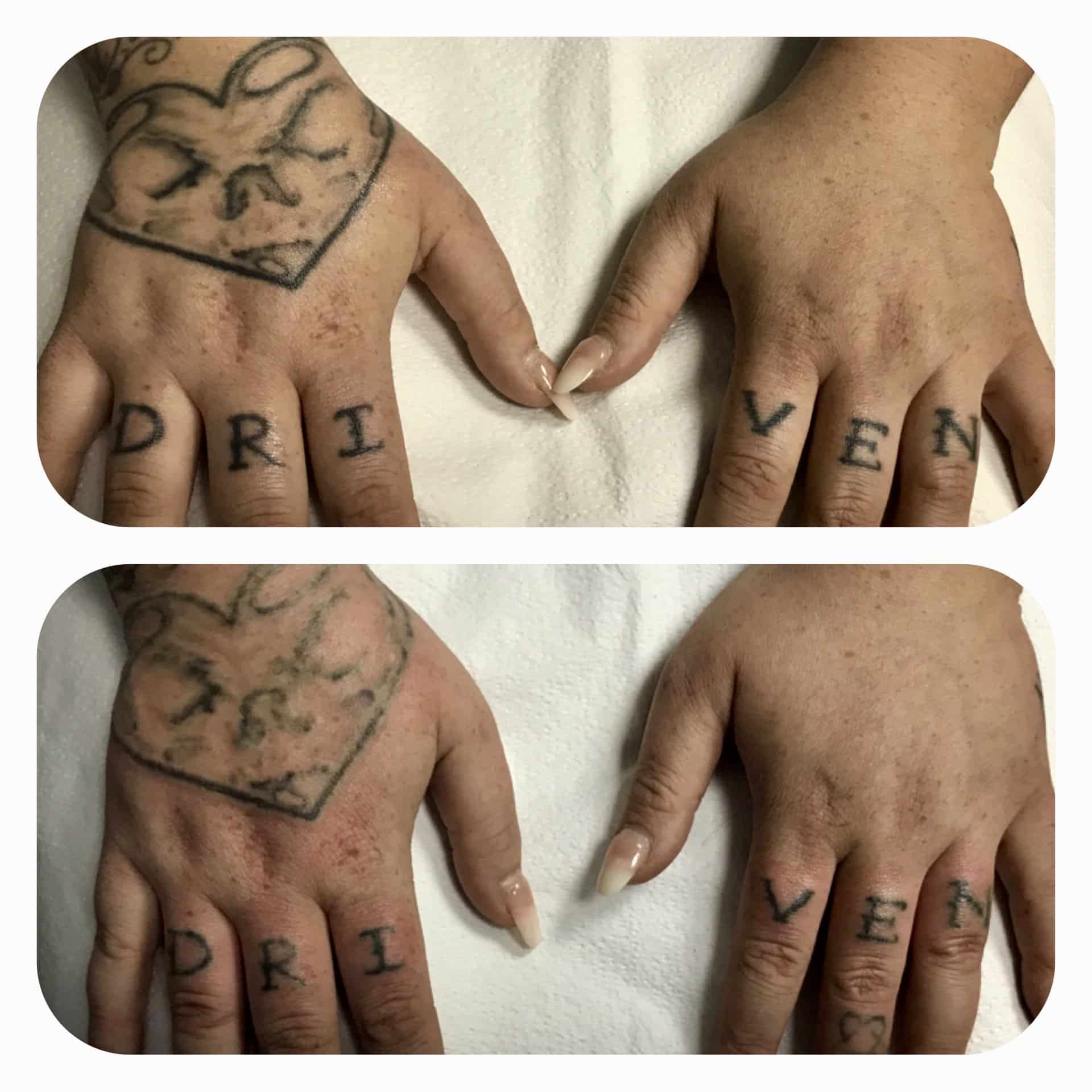 The Best Laser Tattoo Removal in Baltimore, Maryland