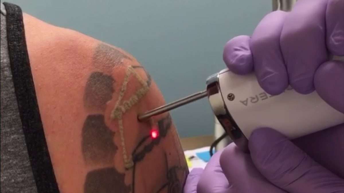 The Best Laser Tattoo Removal in Cleveland, Ohio at Enlighten Aesthetic ...