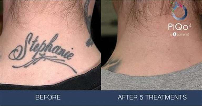 The Effectiveness Of Tattoo Removal Creams â Do They ...