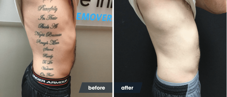 The Laser Tattoo Removal Healing Process