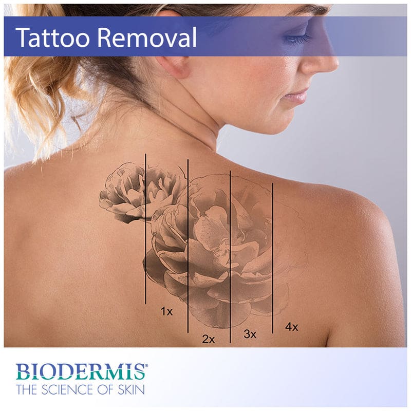 The Scar Management Side of Tattoo Removal