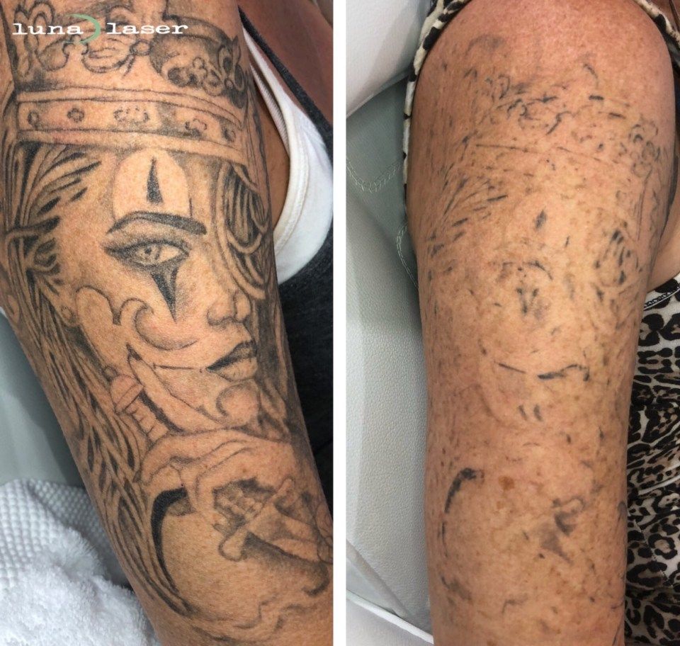 The Shocking Revelation Of How Much Laser Tattoo Removal Cost