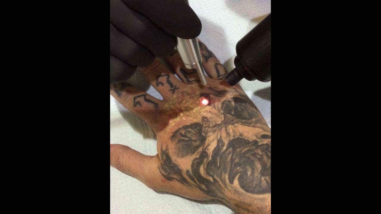 The Tattoo Removal CO. Laser Removal On Hand