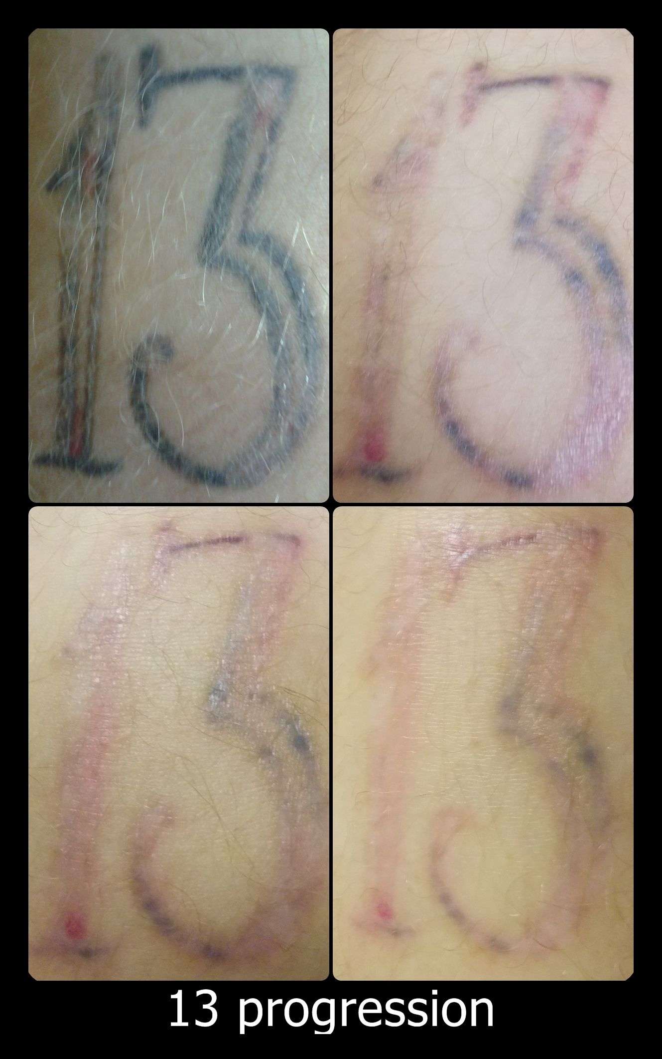 This tattoo had several treatments at another clinic before coming to ...