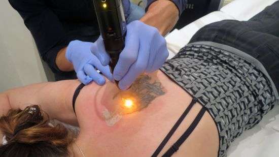 Top 15 Tattoo Removal Tips And Aftercare