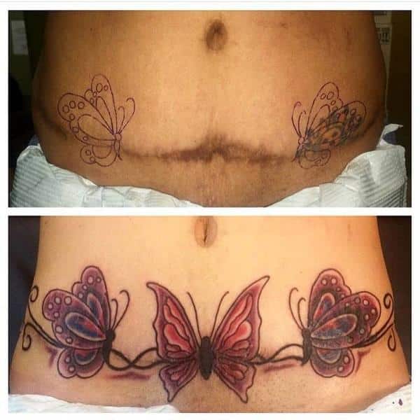 Tummy Tuck Tattoo Cover Ups Pictures (23) » Tummy Tuck: Prices, Photos ...