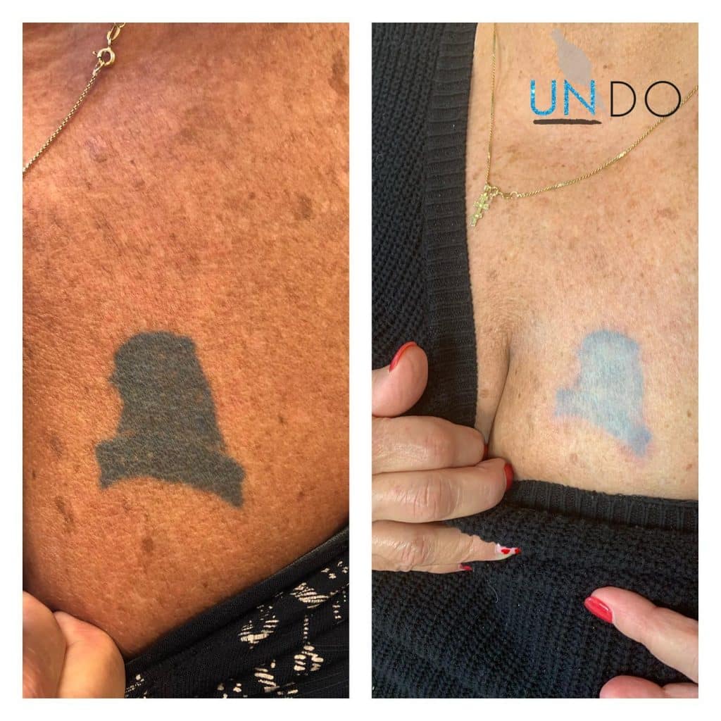 UNDO: Non Laser Tattoo Removal Boca Raton FL, Pittsburgh PA