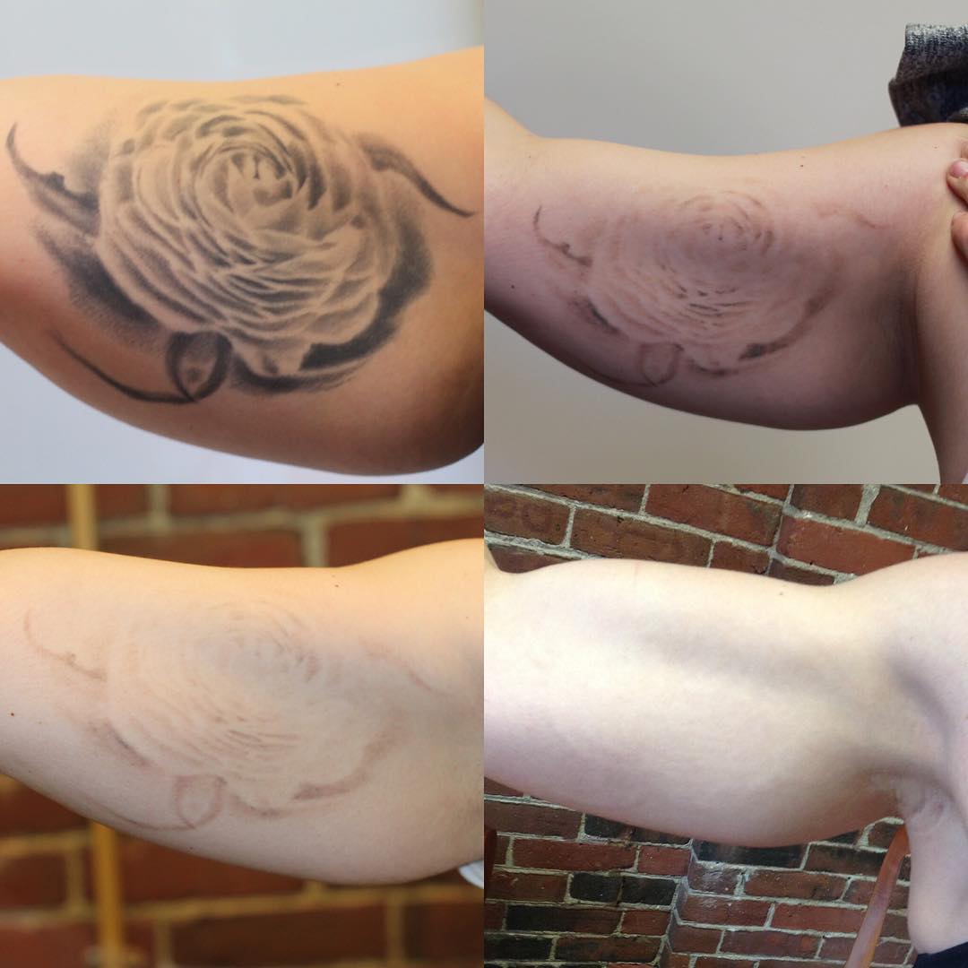 Vol 1: Top 10 Before &  After Tattoo Removal Results