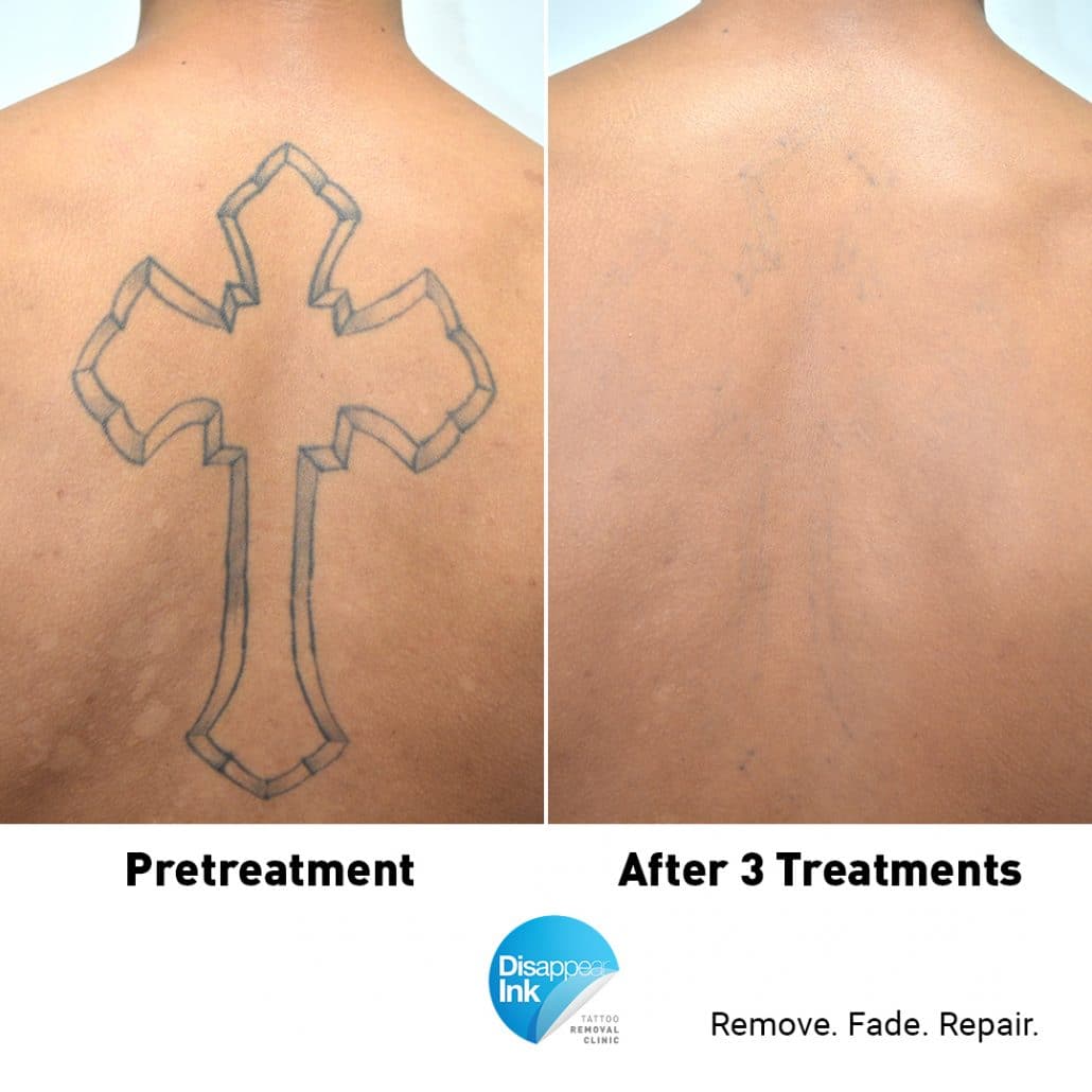 Want the Best Laser Tattoo Removal Results? Before &  After Photos tell all