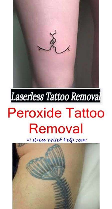 What is tattoo removal.What does tattoo removal look like ...