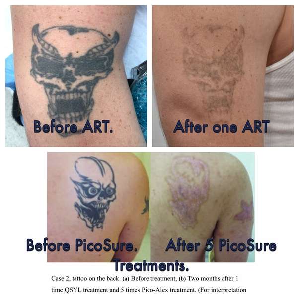 What is the best choice of laser for tattoo removal, Q switch or ...