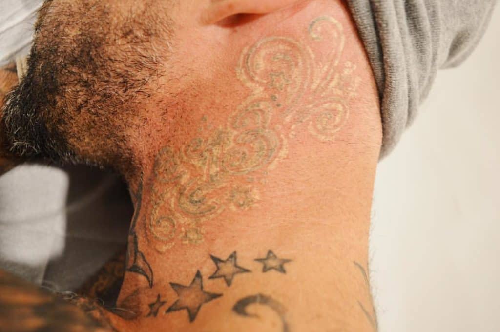 What to Do with Scarring After Laser Tattoo Removal?