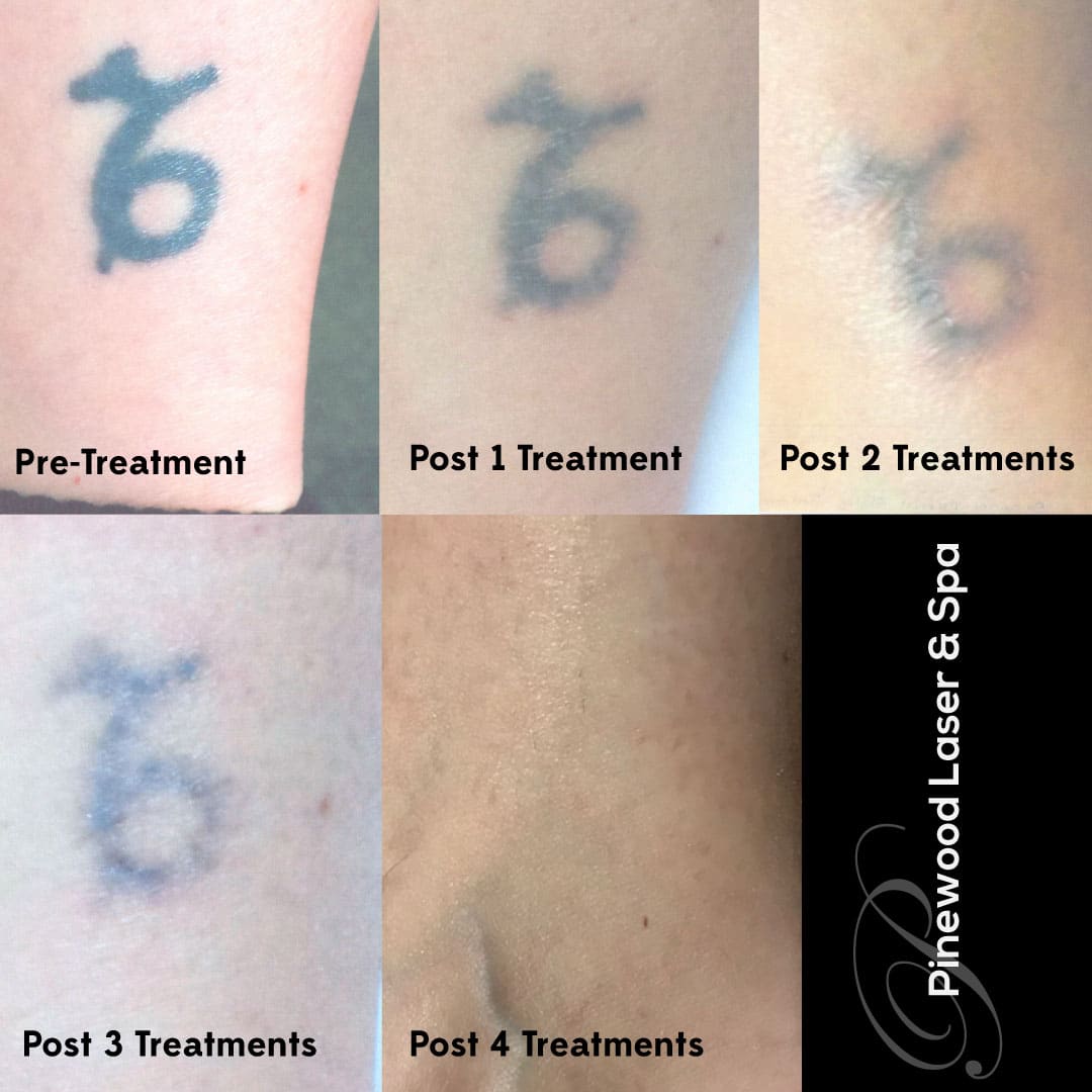 What To Expect After Laser Tattoo Removal / What to expect after laser ...