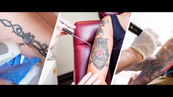 What You Need to Know about Tattoo Removal: Options and Results