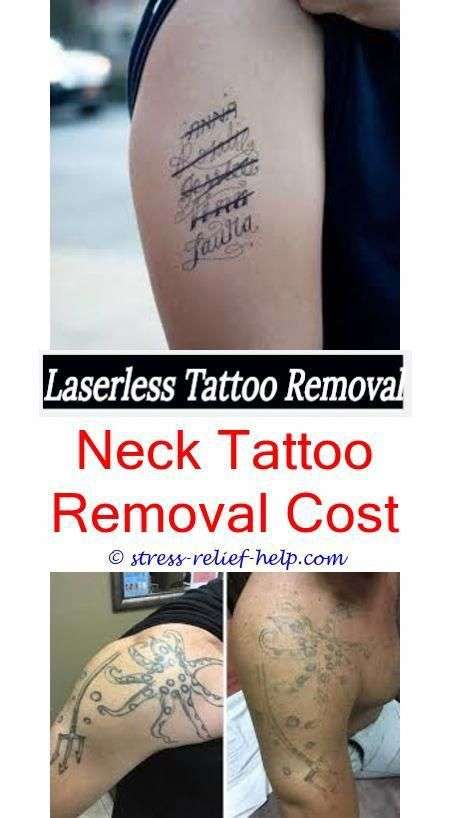 Where to buy tattoo removal cream.Permanent tattoo removal ...