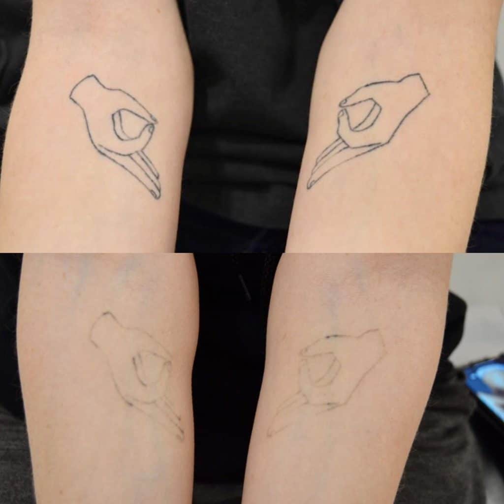Where to Get Laser Tattoo Removal in Toronto?