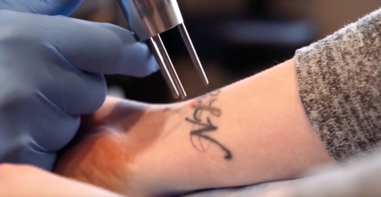 Who can operate a laser and remove tattoos? Heres how to find that out ...