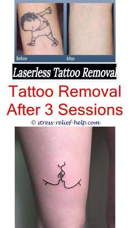 Will tattoo removal get better.Tattoo removal green ink ...