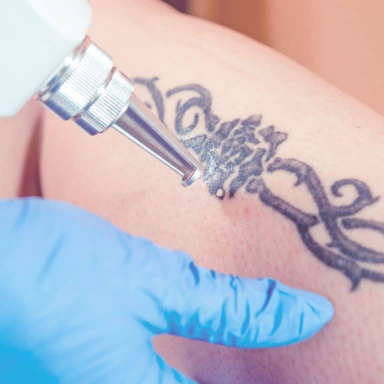With Laser Tattoo Removal Get A Fresh Start At Ingrid E. Trenkle, MD
