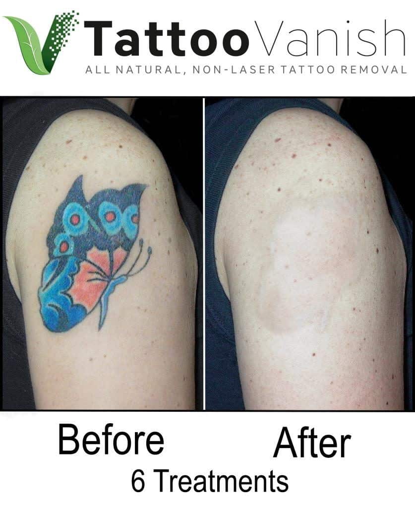 Wrecking Balm Tattoo Remover : Benefits Of Laser Tattoo Removal Know ...